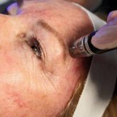 Dermalinfusion - microdermaabraziune cu capete de diamant